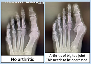 arthritis