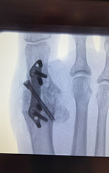 big toe fusion
