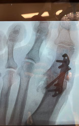 big toe fusion