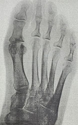 big toe fusion