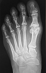 big toe fusion