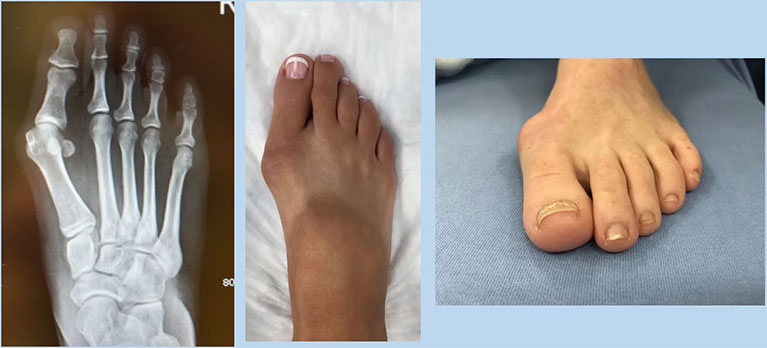 bunion