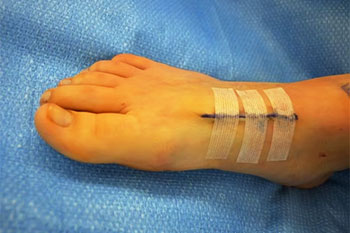 bunion