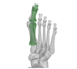 psi patient specific instruments