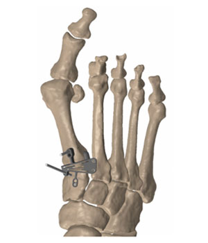 psi patient specific instruments