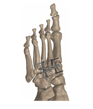 psi patient specific instruments