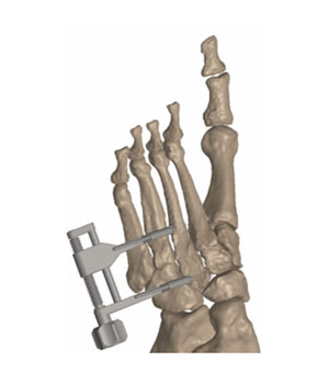 psi patient specific instruments