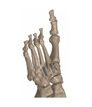 psi patient specific instruments