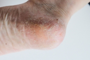 When Cracked Heels Become a Serious Concern
