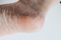 When Cracked Heels Become a Serious Concern